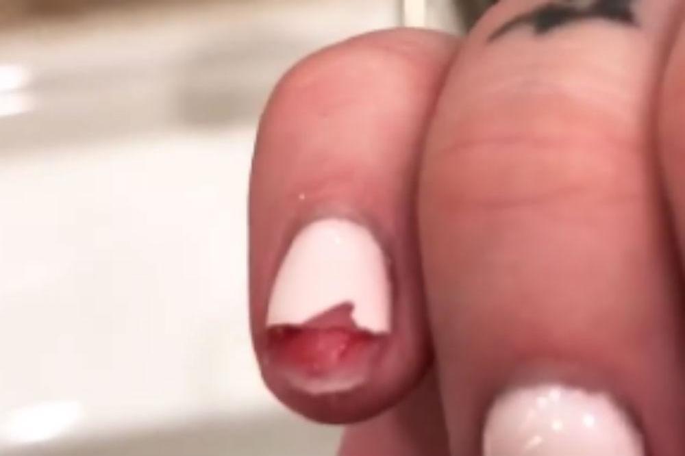 Iggy Azalea's bloody nail (c) Instagram