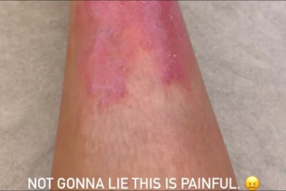 Kim Kardashian has had a painful flare-up of psoriasis