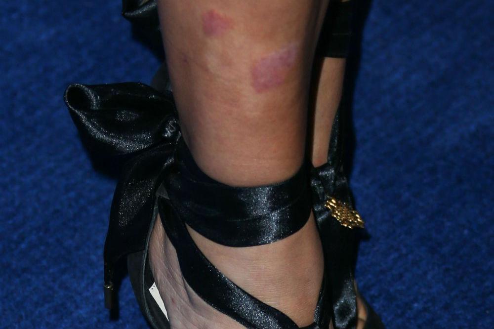 Kim Kardashian West develops leg rash 