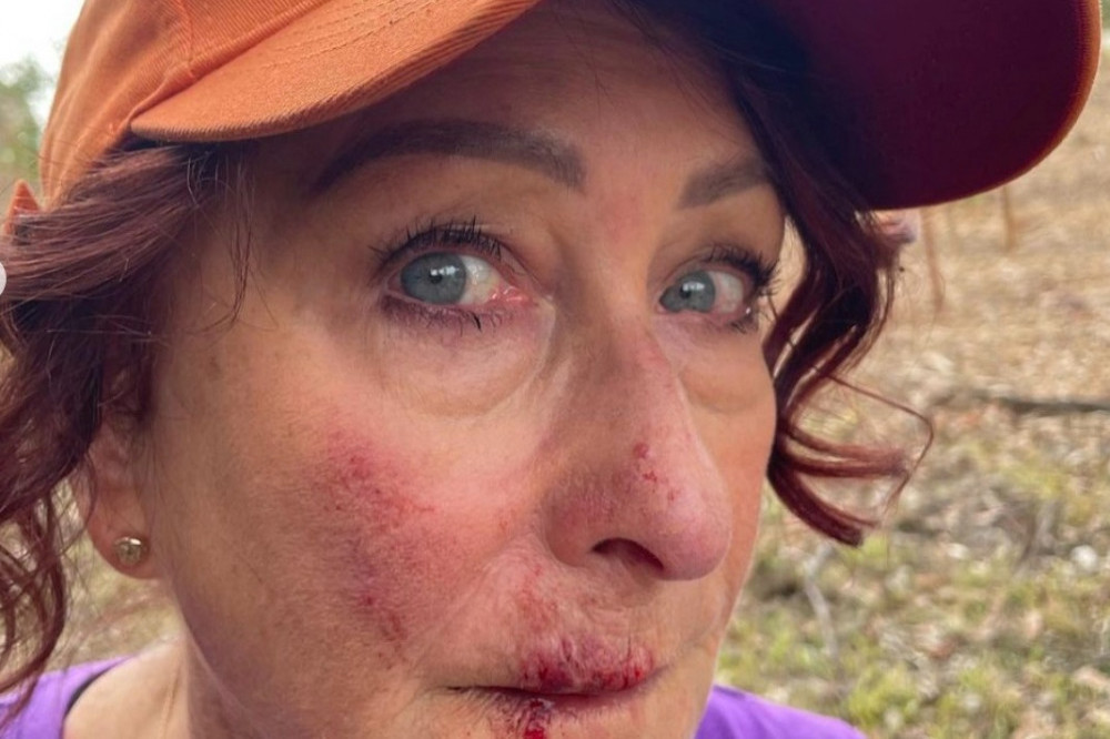 Lynne McGranger shocked social media with her bloody face - Instagram-Lynne McGranger