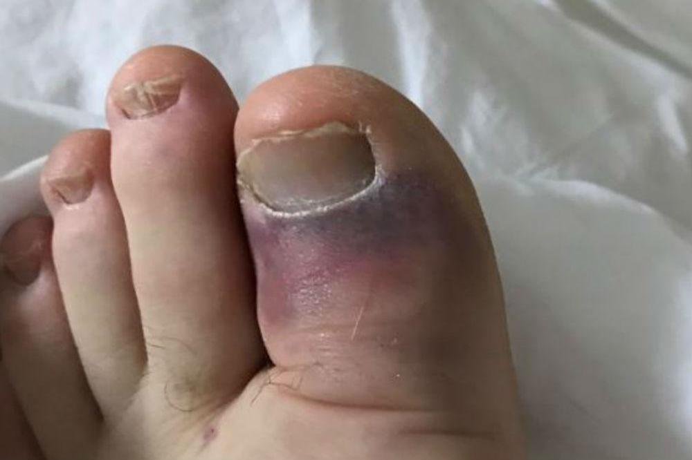 Ross Kemp's broken toe (c) Twitter