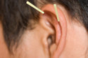 Ear acupuncture can help people lose weight