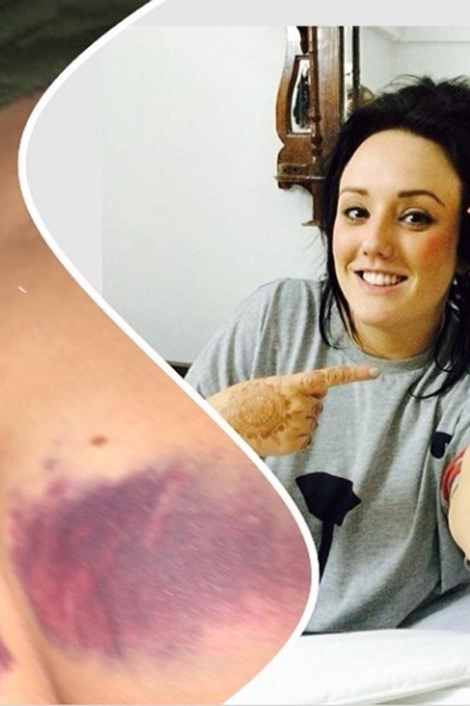 Charlotte Crosby's bruises (c) Instagram