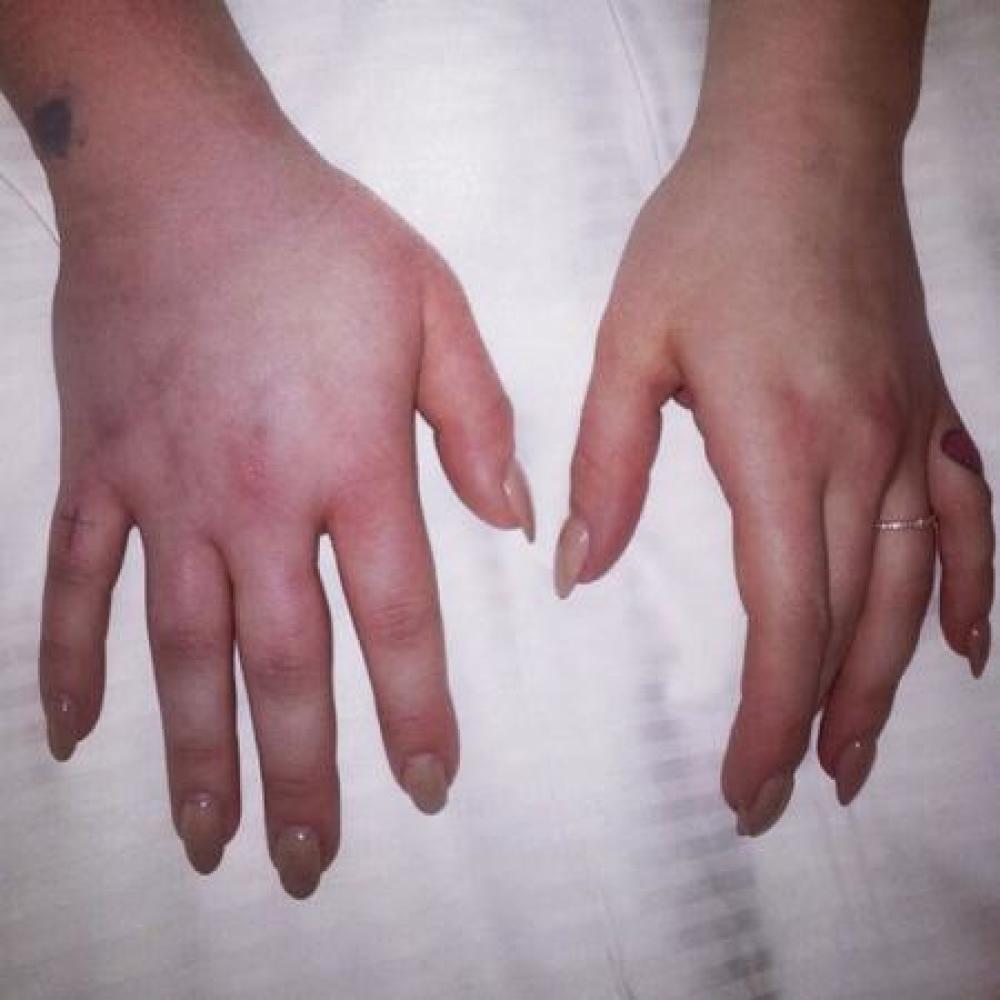 Kelly Osbourne's bruised hand (c) Instagram