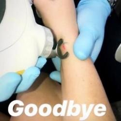 Charlotte Crosby gets Bear ink lasered (c) Instagram 