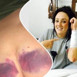 Charlotte Crosby's bruises (c) Instagram