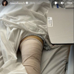Dawn French undergoes knee surgery 14 years after recreating Vicar of Dibley puddle stunt - Instagram-DawnFrench