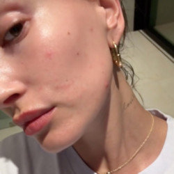 Hailey Bieber is suffering a “pretty bad flare up” of her perioral dermatitis