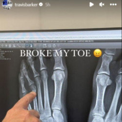 Travis Barker's broken toe - Instagram