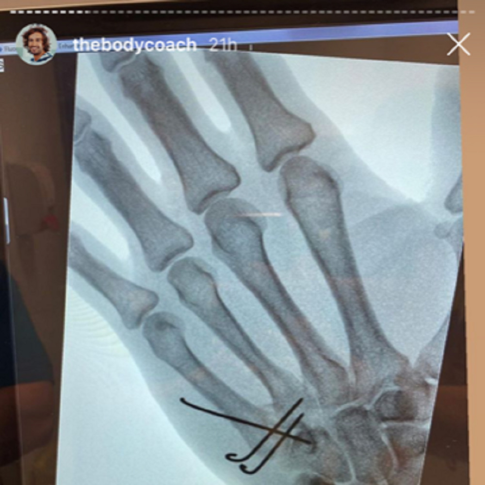 Joe Wicks' hand X-ray
