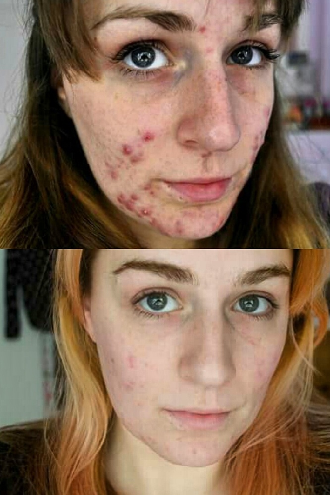 My Disfiguring Painful Acne Disappeared After I Went Vegan