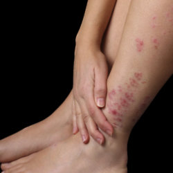 Busting Eczema Myths