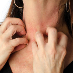 Psoriasis is a chronic skin condition which causes red, flaky, crusty patches of skin