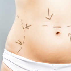 Enquiries About Liposuction Increase  By 75%