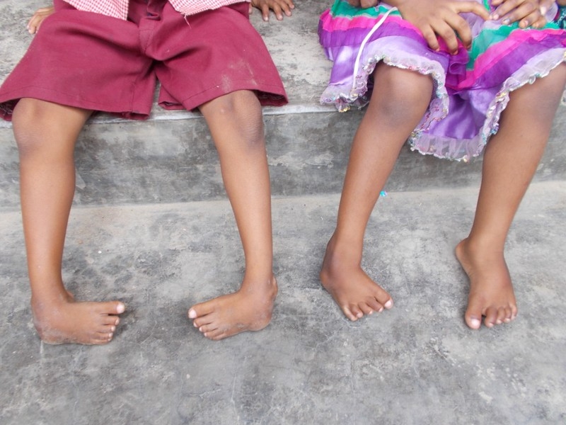 MiracleFeet aims to raise awareness of clubfoot throughout the world