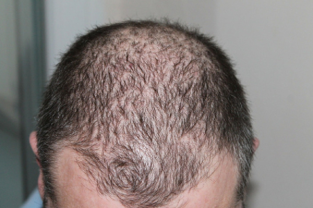 Nutrition and Hair Thinning