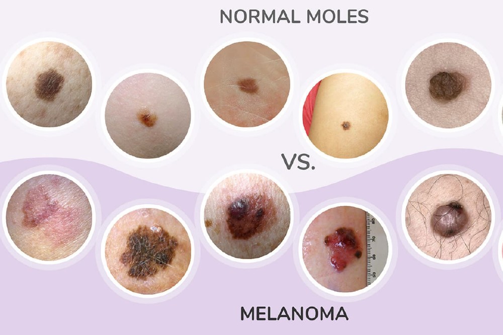 What are 'normal' moles? Photo credit: Miiskin
