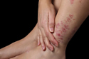 Busting Eczema Myths