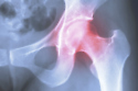 Osteoarthritis is a condition that affects the joints