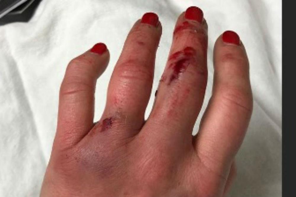 Candace Cameron Bure's swollen hand (c) Instagram