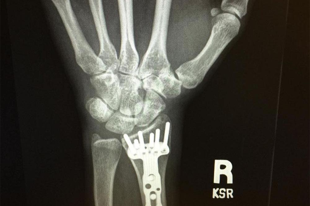 Carrie Underwood's X-ray scan (c) Instagram