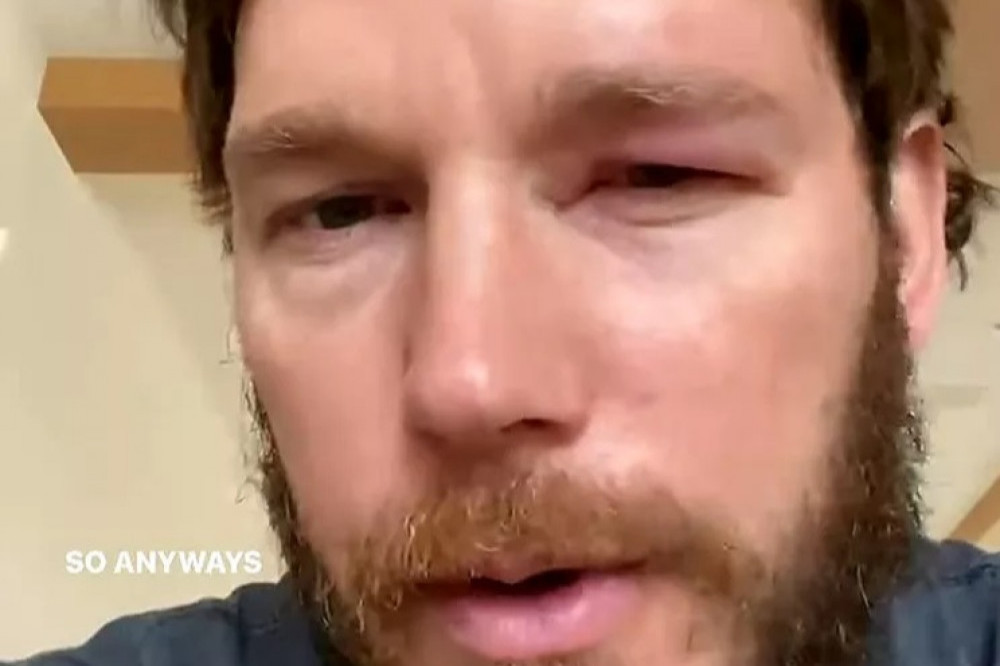 Chris Pratt was stung by a bee (c) Instagram
