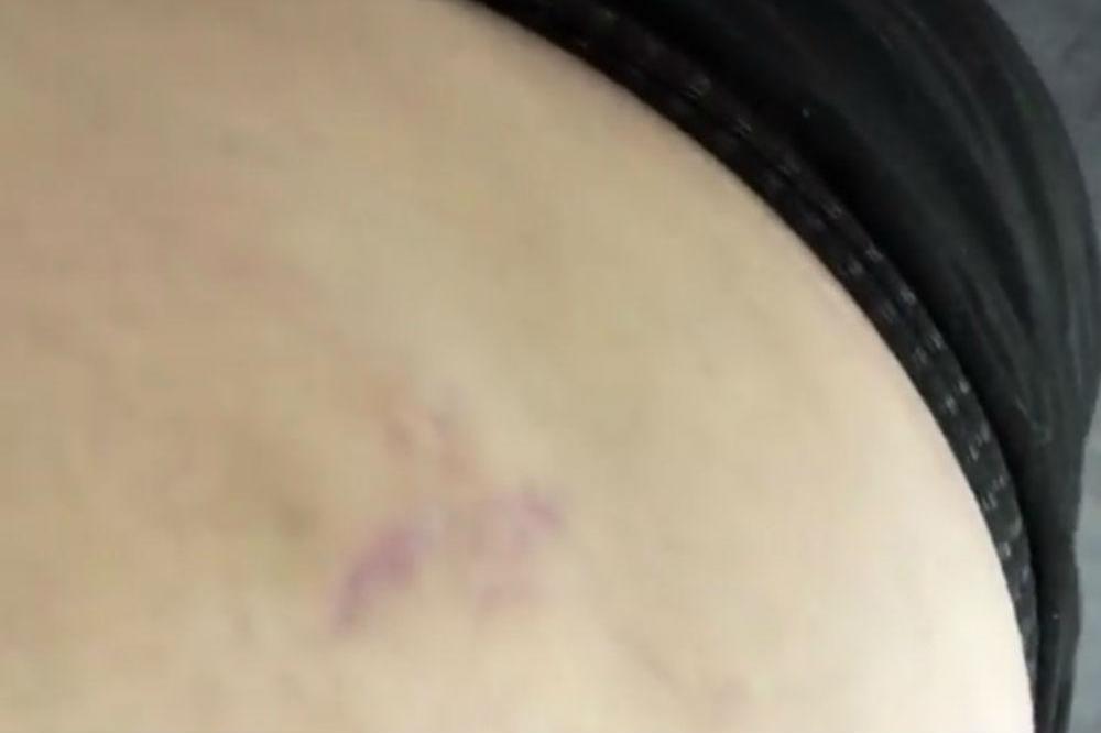 Chrissy Teigen's stretch marks (c) Instagram
