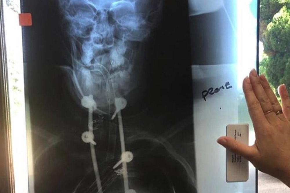 Princess Eugenie's X-ray (c) Instagram