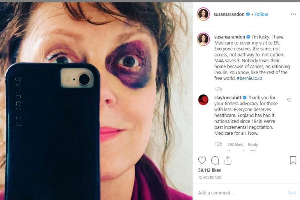 Susan Sarandon's black eye (c) Instagram