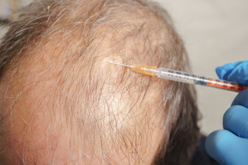 A simple injection can prevent baldness