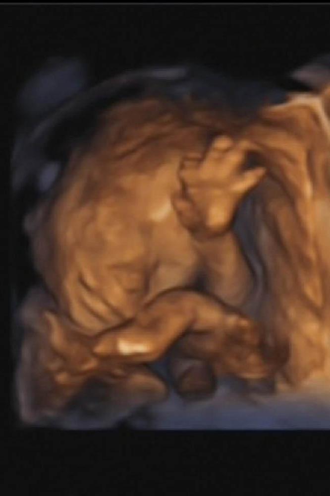 JJ Hamblett's baby ultrasound