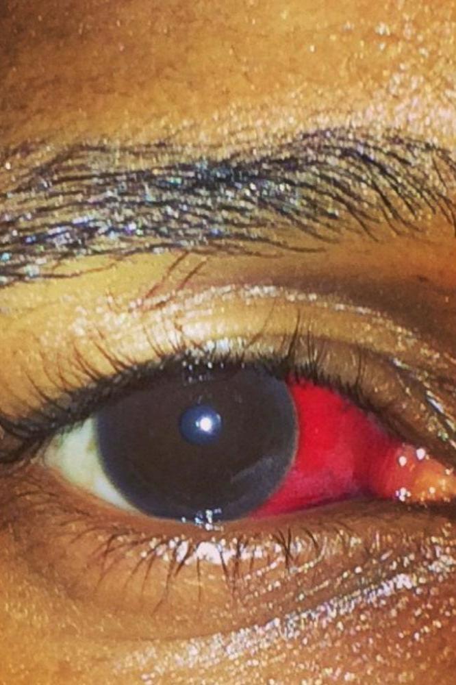 Usher's eye injury