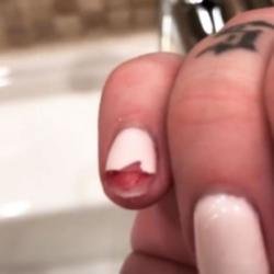 Iggy Azalea's bloody nail (c) Instagram
