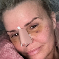 Kerry Katona is healing after nose surgery
