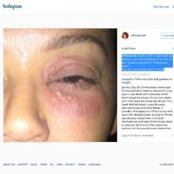 Mel B shows eye infection (c) Instagram