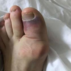 Ross Kemp's broken toe (c) Twitter