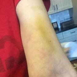Sarah Silverman's bruised arm (c) Facebook