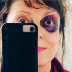 Susan Sarandon's black eye (c) Instagram
