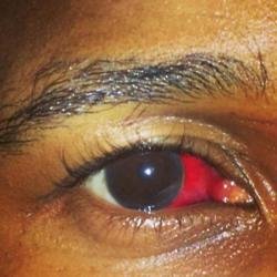 Usher's eye injury