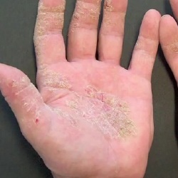 Do you cover up your eczema?