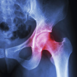 Osteoarthritis is a condition that affects the joints