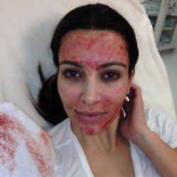 Kim Kardashian reveals the effects of a vampire facial