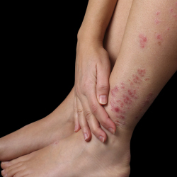 Psoriasis is an incurable condition