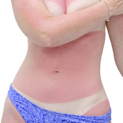 Don't suffer with sunburn this summer, take care of your skin